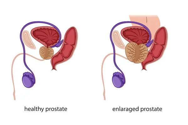 Prostate Enlargement