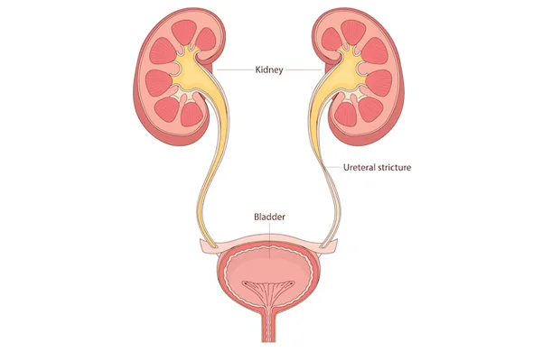 Urethral Stricture