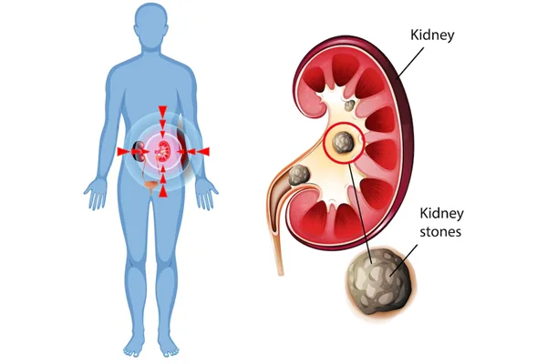 Kidney Stone Treatment