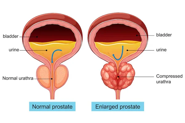 Prostate & Bladder Care