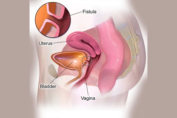 Vesicovaginal Fistula VVF