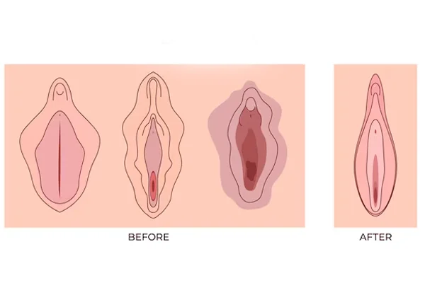 Labiaplasty